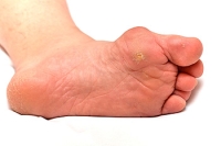 Medical Procedures for Foot Corns