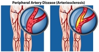 Symptoms and Risk Factors of PAD Affecting the Feet